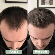 Serum Roll-On para el Crecimiento Capilar